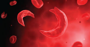 Blood Cells in the shape of Sickles 